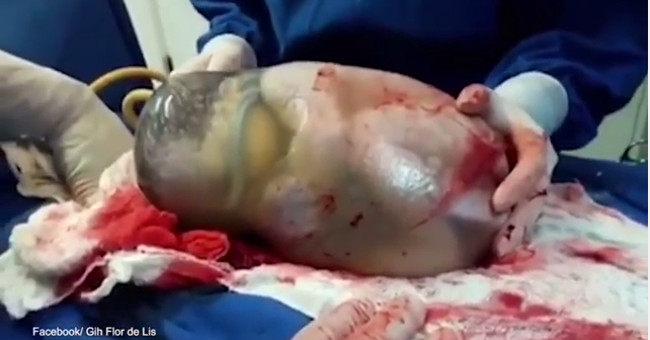 Video: A rare moment when a newborn baby is born in the amniotic membrane