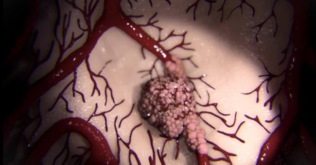 Video: See for yourself the cancer cells spread throughout the body