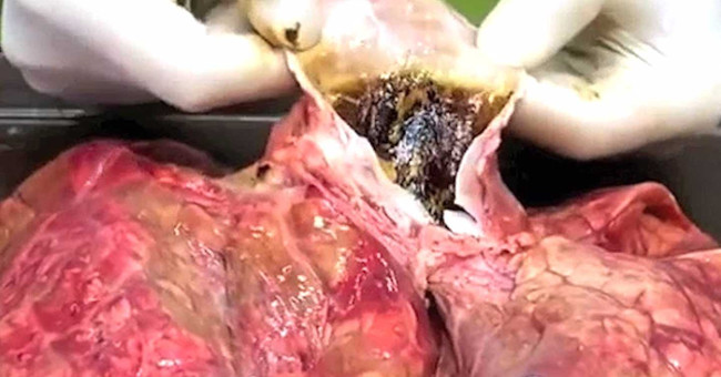 Video: The lungs are dark after smoking 20 cigarettes