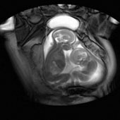 Video: Twins kick together to win space in the womb