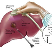 Vietnam has successfully treated liver cancer with radioactive microspheres