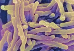 Vietnam produces paper sticks that identify TB bacteria on people