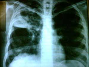 Vietnam ranks 13th in the world in terms of the number of people suffering from TB