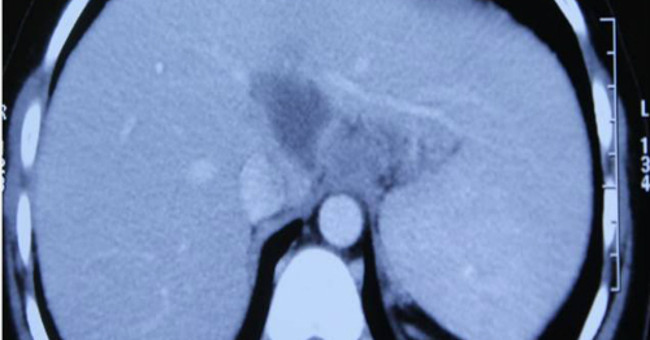 Vietnamese girl became the second rarest case of tuberculosis in the world