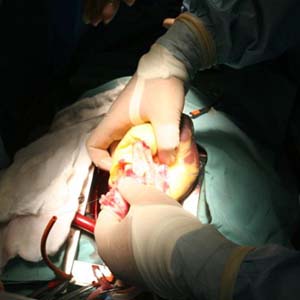 Vietnamese heart doctor successful heart transplant