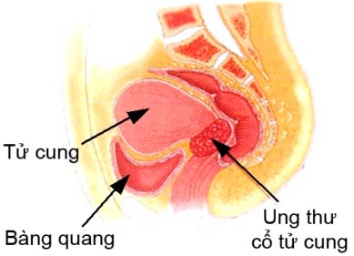 Vinegar: Cervical cancer reagent
