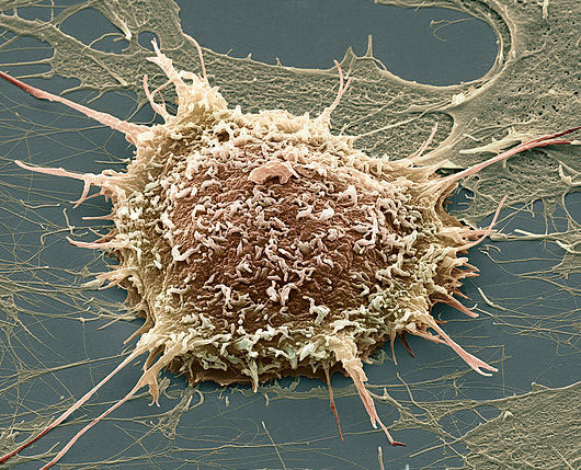 Vinegar helps detect cervical cancer