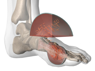 Vitamin C reduces the risk of gout