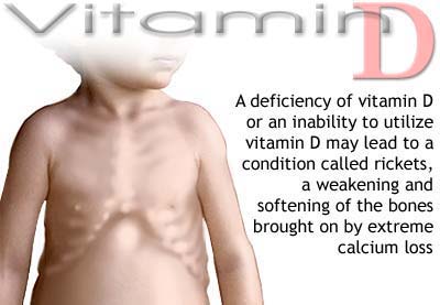 Vitamin D deficiency in children