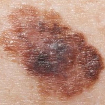 Warning of antioxidants accelerates cancer metastasis