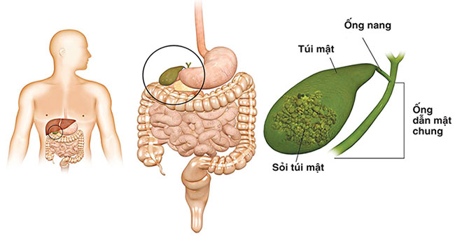 Warning of cholangiocarcinoma of the liver