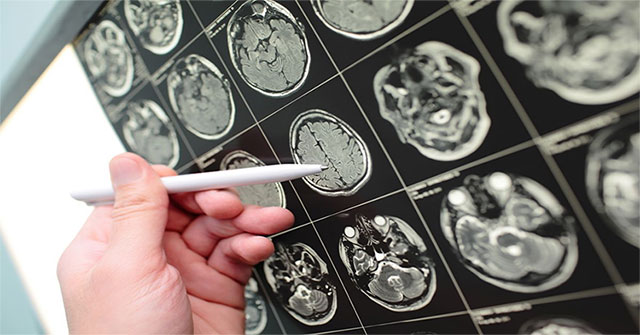 Warning signs for brain tumors