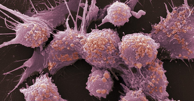 Warning signs for prostate cancer