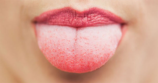 Warning signs of tongue cancer
