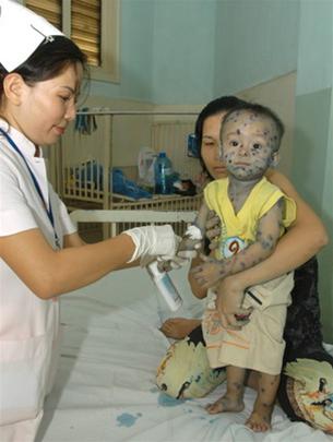 Watch out for complications from chickenpox