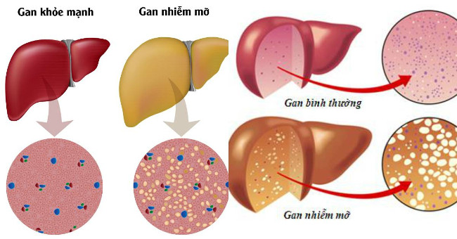 Watch out for signs of fatty liver disease