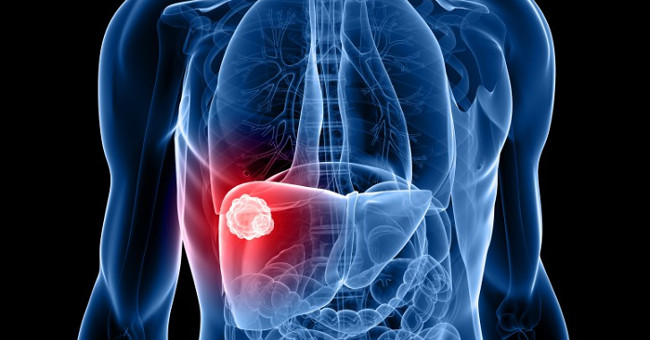 Watch out for signs of liver cancer like artist Bao Quoc