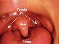 Watch out for tonsillitis
