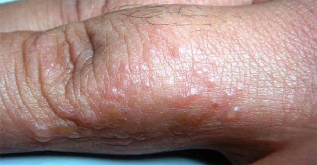 Water scabies: Expression, cause and treatment