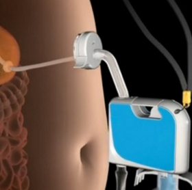 Weight loss with food suction