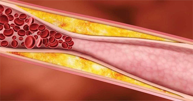 What are blood fats?  Diet for people with fatty blood