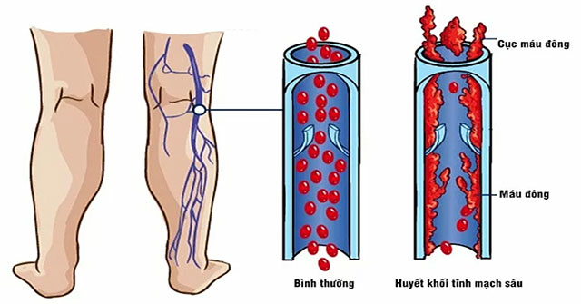 What are venous thromboembolism?