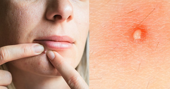 What created acne?