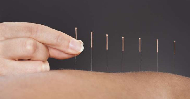 What is acupuncture?