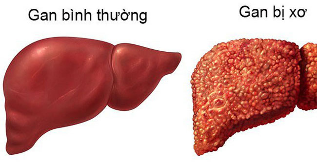 What is cirrhosis?  Who is most likely to develop cirrhosis?
