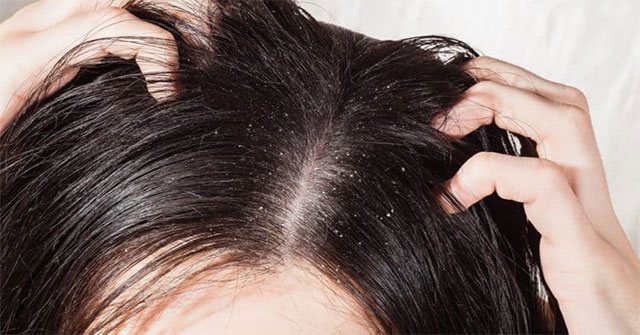 What is dandruff?