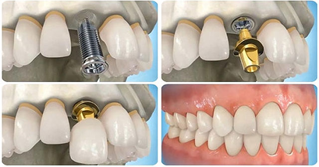 What is dental implant?