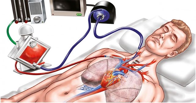 What is ECMO?  When does the patient need ECMO intervention?
