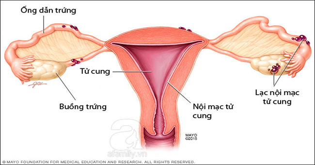 What is endometriosis?  Is it dangerous?