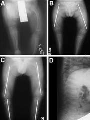 What is glass bone disease?