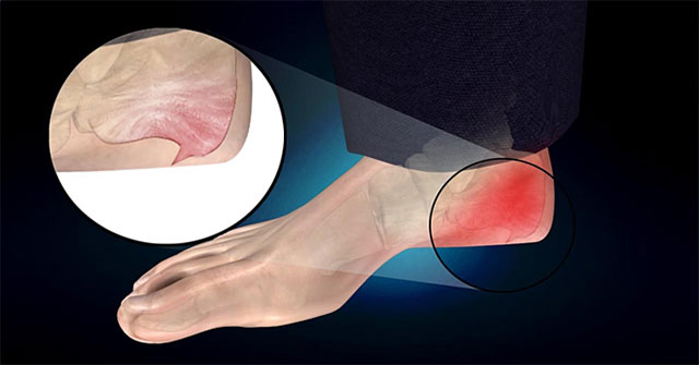What is heel bone spines?