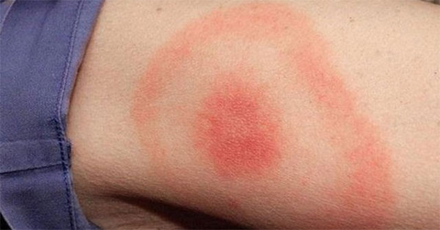 What is Lyme disease?