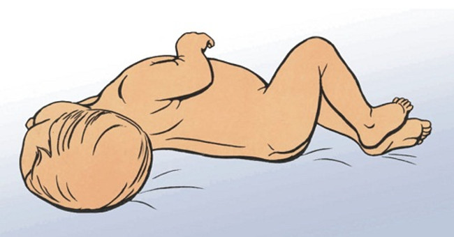 What is meningeal syndrome?