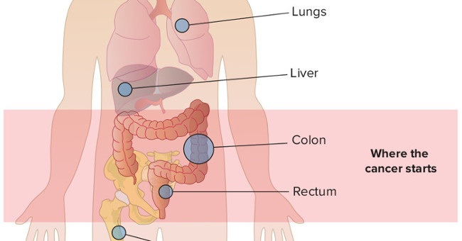 What is metastatic cancer?
