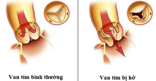 What is open-heart valve disease?