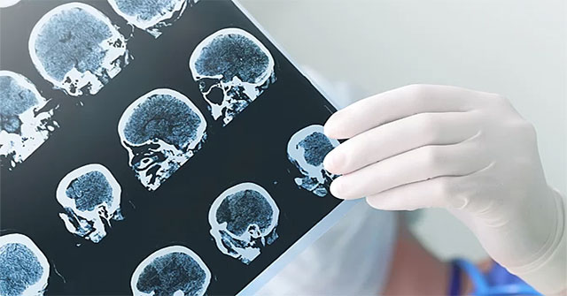 What is pituitary adenoma?