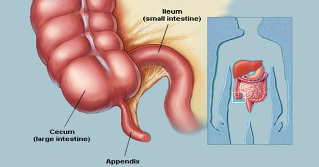 What is the effect of appendicitis?