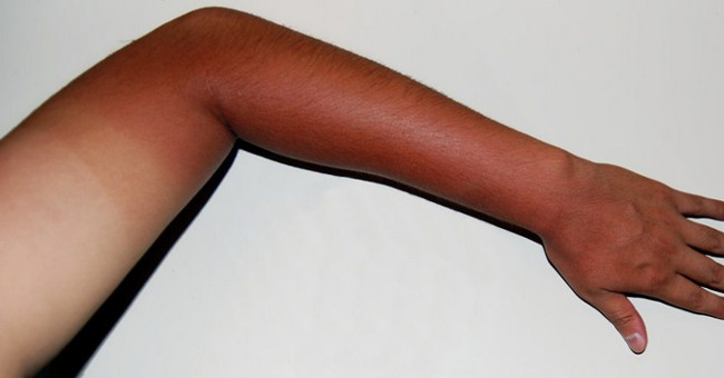 What really happened when we were sunburned?