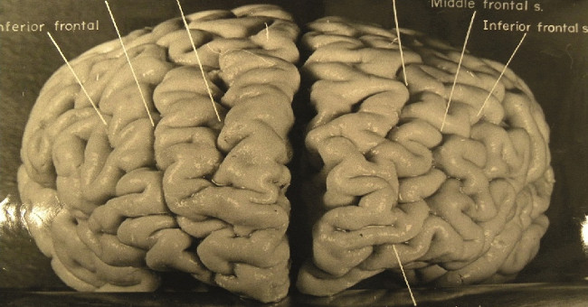 What scientists did with Albert Einstein's brain