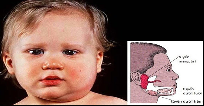 What to do when children have mumps?
