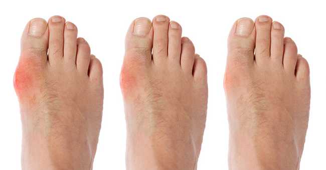 Where does gout come from?