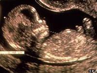 WHO: 68,000 deaths every year for abortion