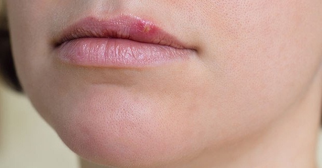 WHO warns: 50% of the world's population can get Herpes