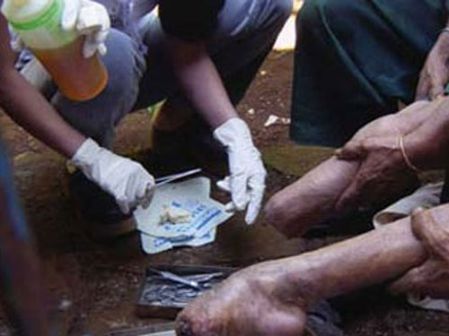 WHO warns that leprosy is spreading rapidly in India