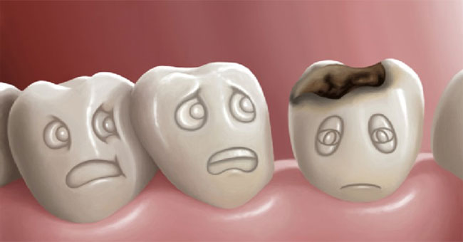 Why are dental caries no pain and scary as you think?