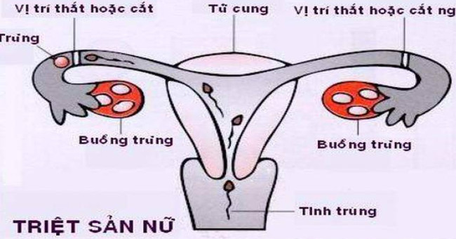 Why can women sterilize and still be able to stick?